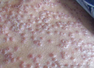 湿疹发病有什么症状？怎么对待湿疹瘙痒？